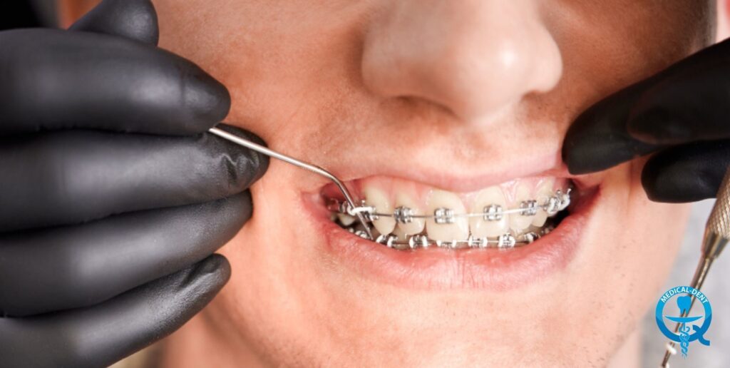 Obraz przedstawia z bliska usta osoby, której zęby są unieruchomione aparatem ortodontycznym. Widoczne są ręce dentysty w czarnych rękawiczkach, wymieniające druty w aparacie za pomocą specjalnych narzędzi. Jest to etap standardowej procedury leczenia ortodontycznego, mający na celu stopniowąkorektę ustawienia zębów.