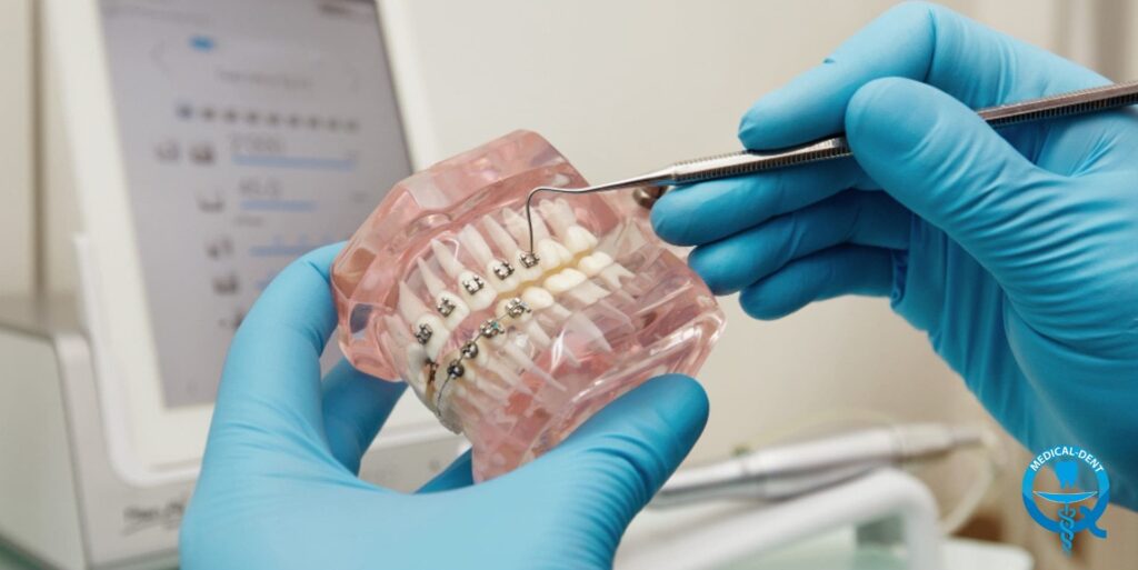 Alt text: "Dłonie w niebieskich rękawiczkach medycznych trzymają przezroczysty model szczęki z założonym aparatem ortodontycznym. Dentysta używa narzędzia do demonstracji aparatu na modelu."