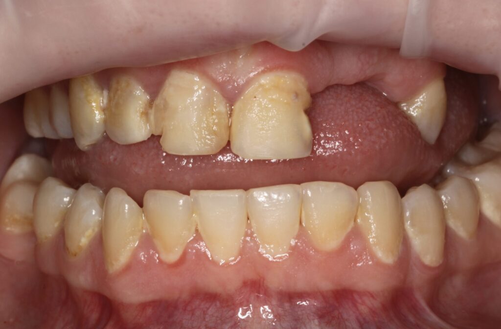 Close-up of a patient's upper and lower teeth with visible discoloration and minor imperfections, prior to dental treatment by Dr. Kamila Szuberska in Birmingham.