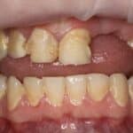 Close-up of a patient's upper and lower teeth with visible discoloration and minor imperfections, prior to dental treatment by Dr. Kamila Szuberska in Birmingham.