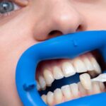 Dentysta używa wzorca koloru do dopasowania zębów podczas zabiegu zakładania licówek, usta pacjenta utrzymywane są przez niebieski retractora stomatologicznego.