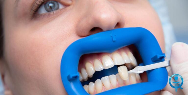 Dentysta używa wzorca koloru do dopasowania zębów podczas zabiegu zakładania licówek, usta pacjenta utrzymywane są przez niebieski retractora stomatologicznego.